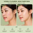 Korean Clinical Acne Reset Combo
